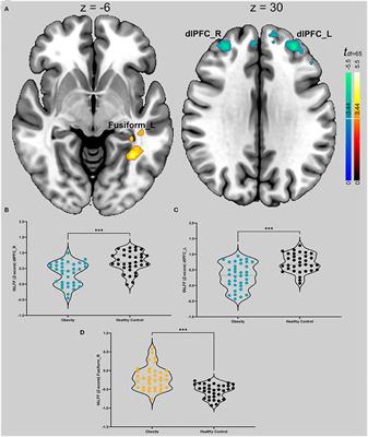 How Impulsiveness Influences Obesity: The Mediating Effect of Resting-State Brain Activity in the dlPFC